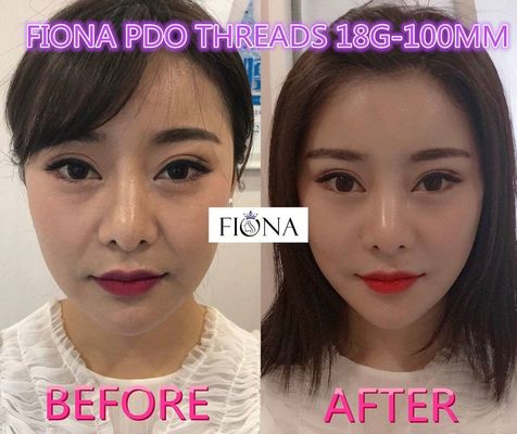 Fiona PDO και νήμα PCL, νήμα ανελκυστήρων PDO προσώπου 38mm