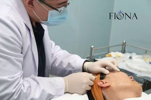 Μη-χειρουργικό πρόσωπο που ανυψώνει τον ανελκυστήρα 360 προσώπου νημάτων βαραίνω PDO PCL PLACL κάννουλα 4D 6D 12D W